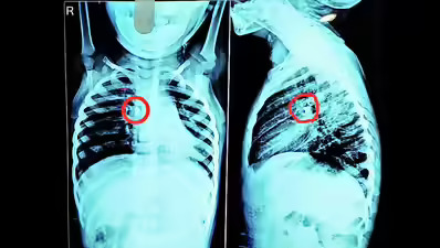 Stone removed from toddler’s windpipe